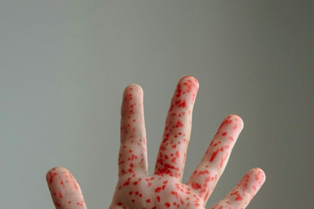 focar de rujeola in nordul londrei peste 60 de copii s au infectat 699155af2e433