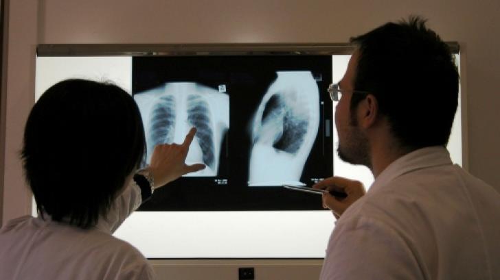 insp romania continua sa inregistreze cea mai ridicata rata a incidentei tuberculozei din ue tristele date ale zilei mondiale a tuberculozei 69c24d51de60b