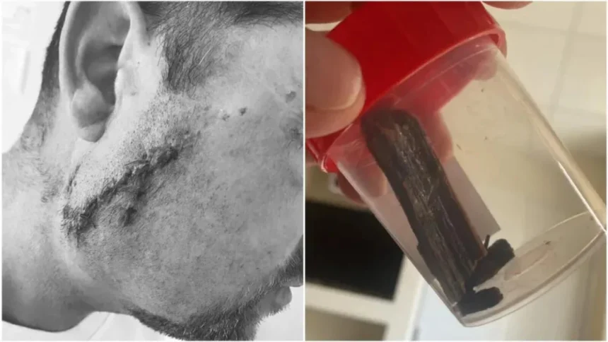 este revoltator ce a patit un pacient dupa ce a ajuns la spital din satu mare un ginecolog i a cusut rana dar in obraz ramasese o bucata de lemn 6a86dfd8266a8